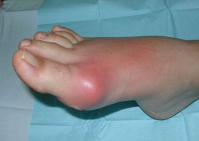 Clinical manifestations of arthritis of the foot - swelling and inflammation