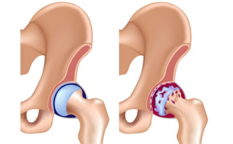 Healthy Hips and Hips Affected by Arthritis