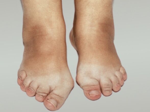 Osteoarthritis of the foot, severe deformation of the toes