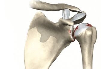 Shoulder joint affected by joint