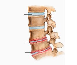 Osteochondral disease