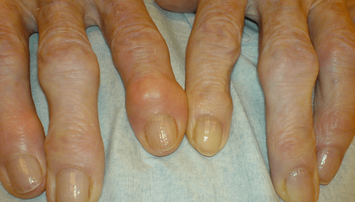 Finger joint pain with osteoarthritis