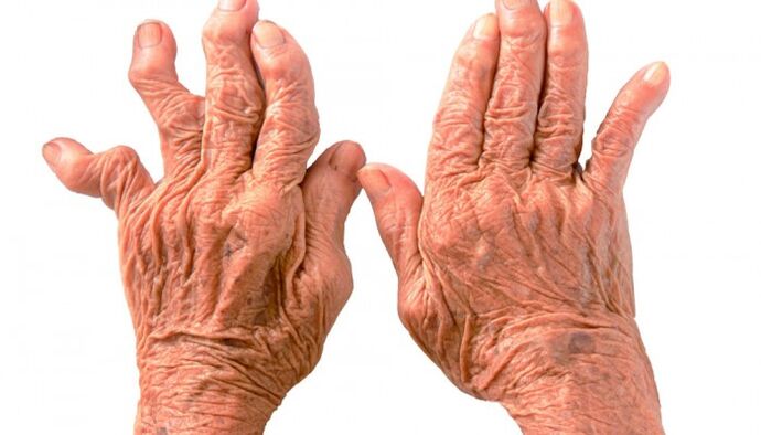 Rheumatoid Arthritis Causes Finger Joint Pain