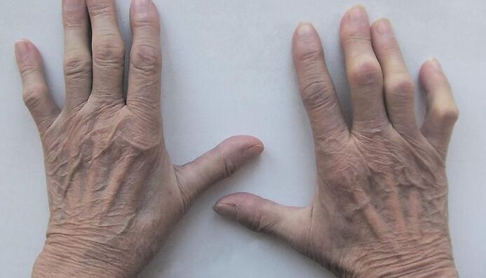 finger joint pain