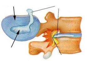 Destruction of annulus fibrosus in cervical osteochondrosis