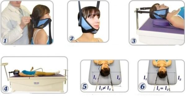 Traction for the treatment of cervical osteochondrosis