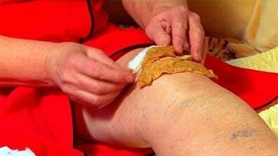 Compress knee joints