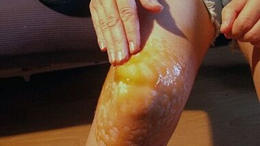 Treatment of the trash in the knee joints