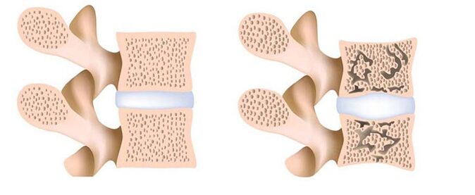Osteoporosis-removing calcium from bones