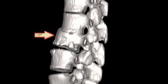 Spine pathology as a cause of back pain