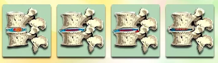The stages of development of degenerative disc disease