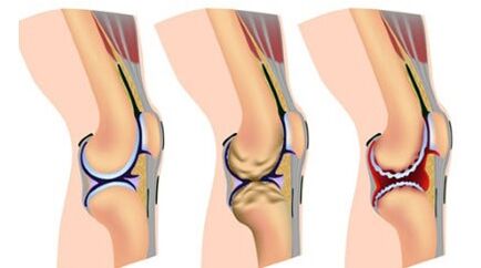 Three degrees of disease