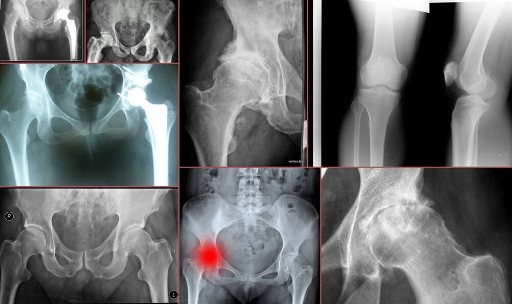 X-ray of hip pain