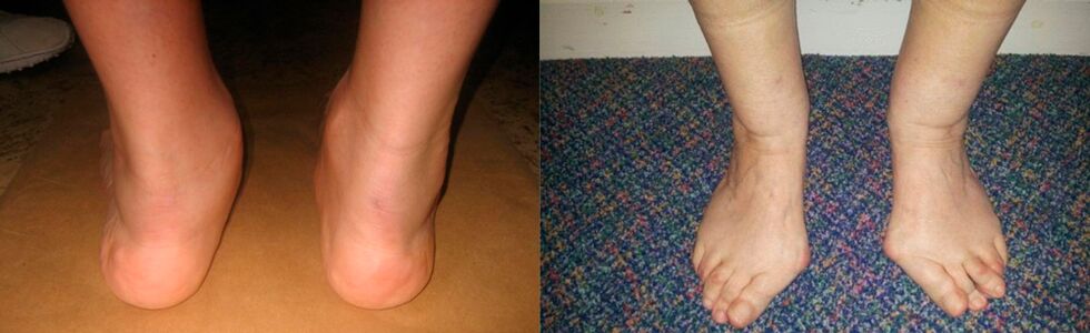 Deformation of the big toe and ankle joints
