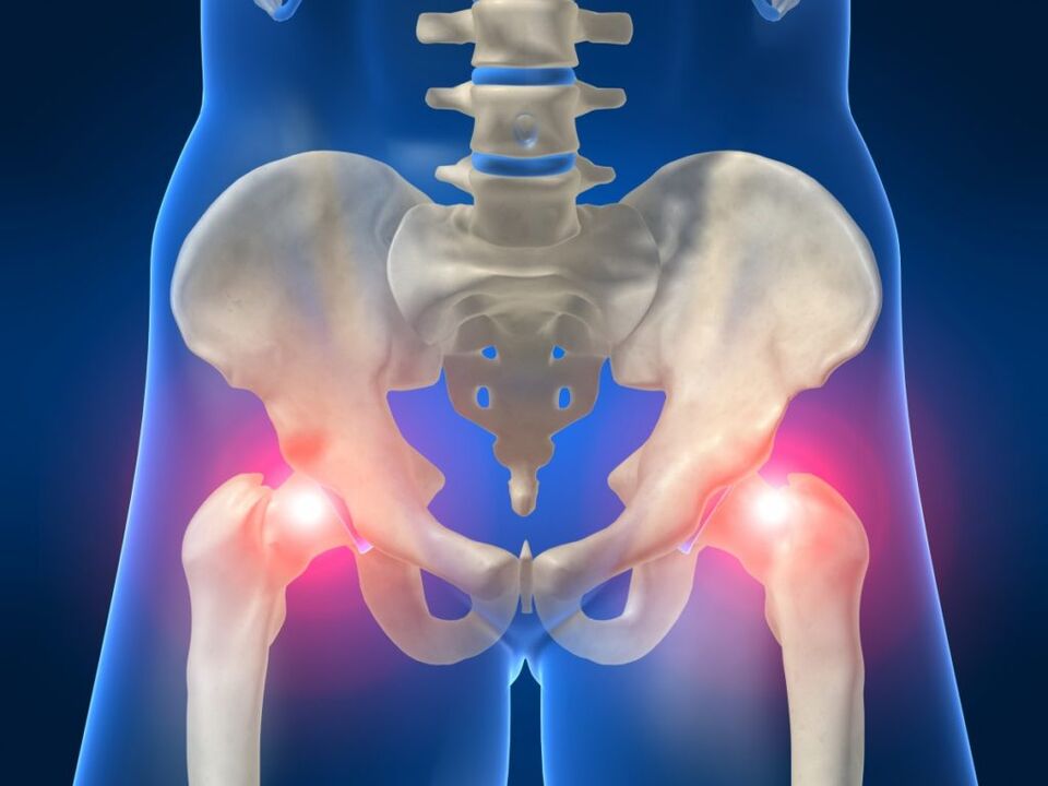 Disturbing bilateral pain in the hip joint in ankylosing spondylitis