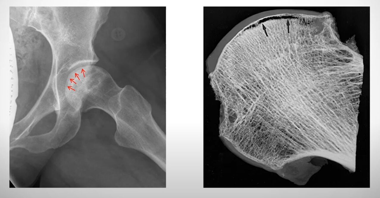 X-ray of aseptic necrosis affecting the femoral head