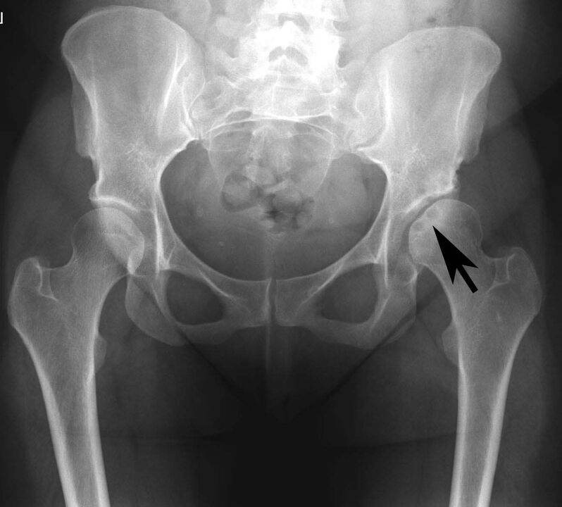 X-ray pseudogout hip calcium deposits