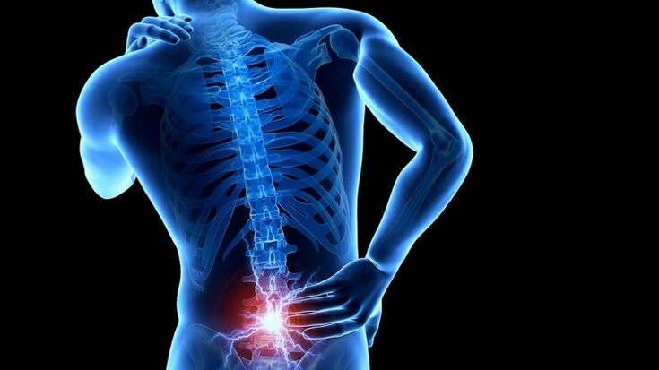 Low back pain with lumbar osteochondrosis