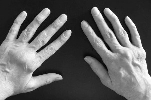 the disease hands